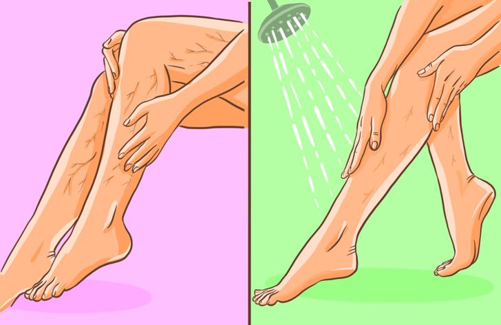 7 Exercises to Reduce Spider and Varicose Veins
