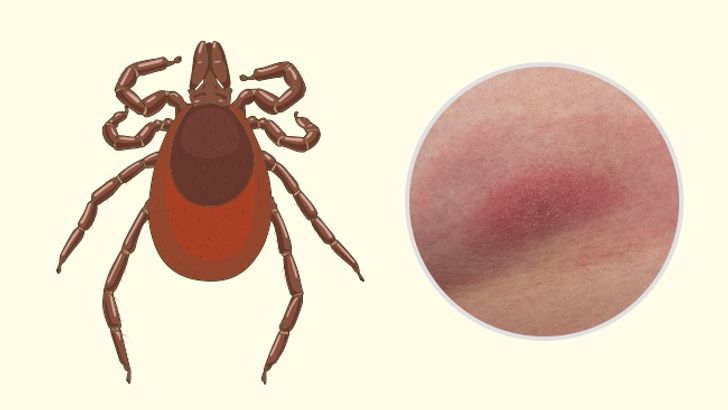 10 Bug Bites Anyone Should Be Able to Identify