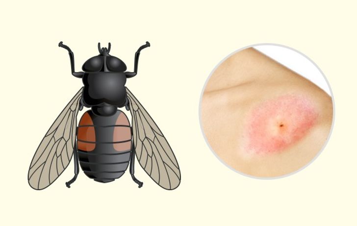 10 Bug Bites Anyone Should Be Able to Identify