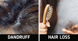 Dandruff and hair loss