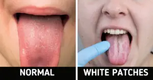 White patches on the tongue