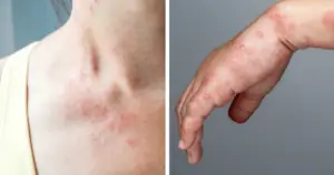 Skin rashes