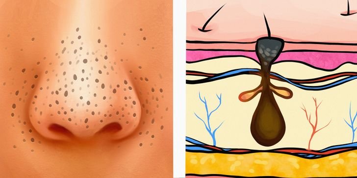 Blackheads